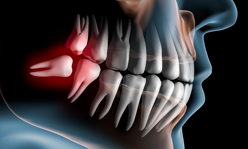 Denti del giudizio: quando toglierli, come curarli e prevenire il dolore