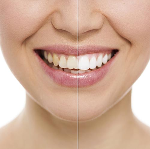 Come avere denti bianchi: 5 metodi infallibili
