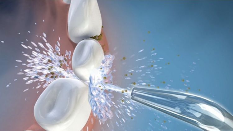 Idropulsore dentale: pulire i denti col getto d’acqua