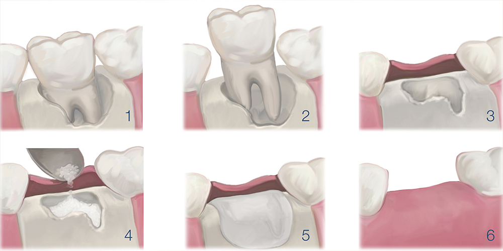 Chirurgia orale: innesti e rigenerazioni ossee