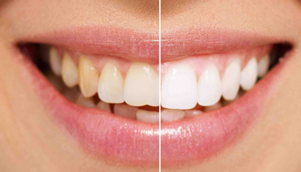 Denti e macchie