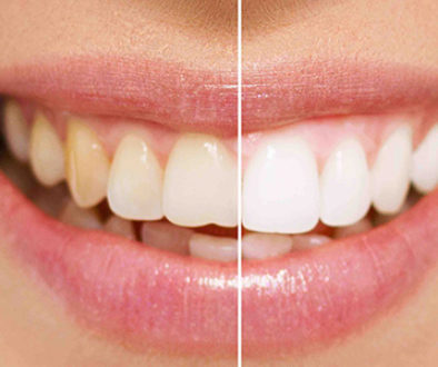Denti e macchie
