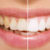 Denti e macchie