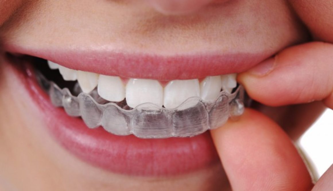 denti apparecchio