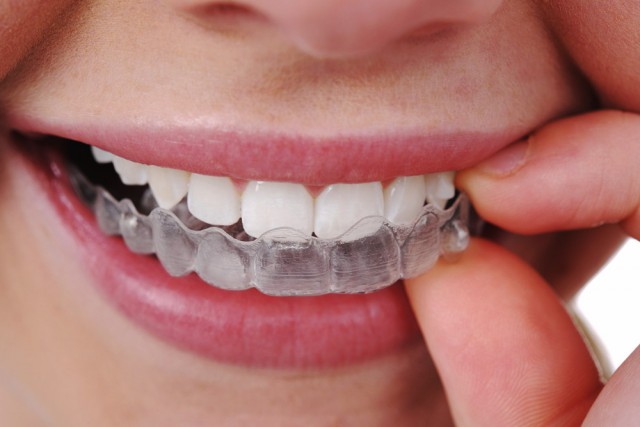 Denti storti, sporgenti: a che età intervenire?